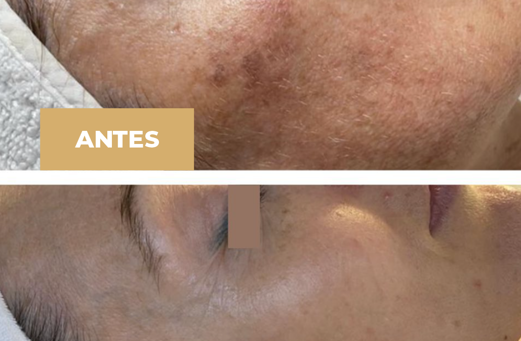 Tratamientos para eliminar manchas faciales: preguntas frecuentes