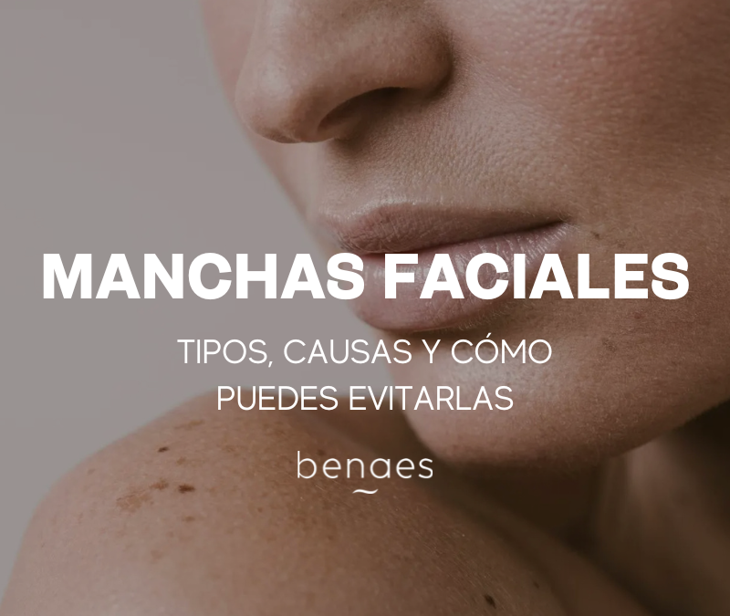 Manchas en la cara: tipos, causas y cómo evitarlas 