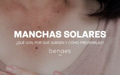 Manchas Solares – Qué son, Por qué surgen y Cómo prevenirlas