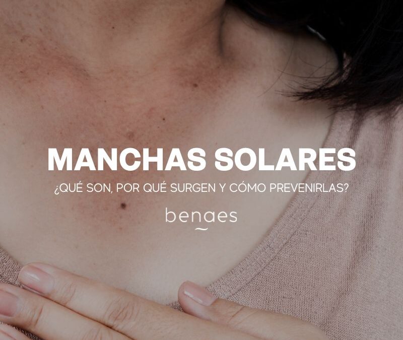 Manchas Solares – Qué son, Por qué surgen y Cómo prevenirlas