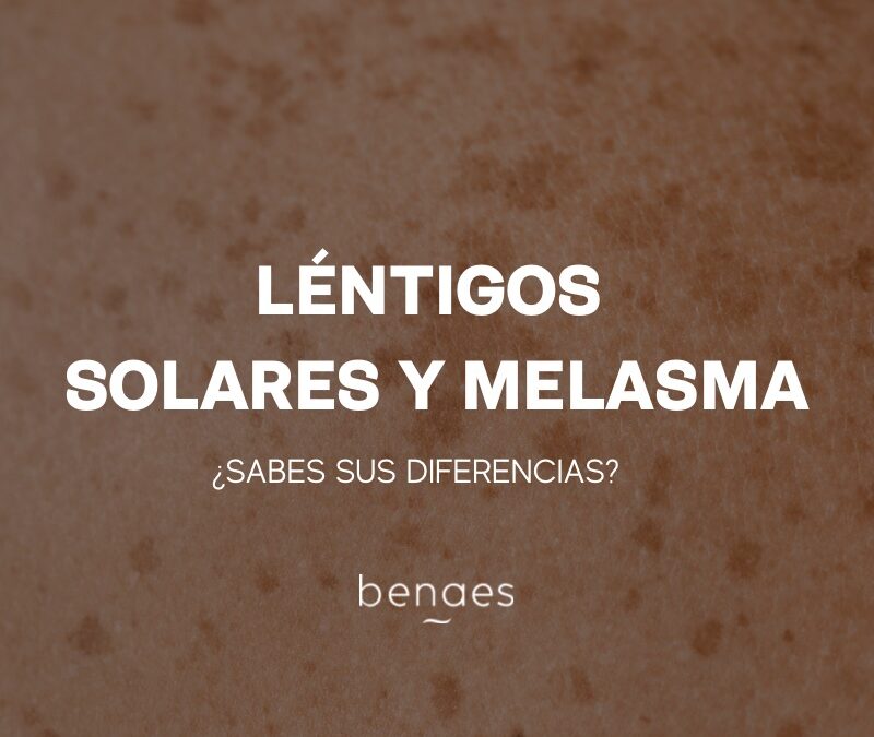 ¿Cuáles son las diferencias entre los léntigos solares y el melasma?