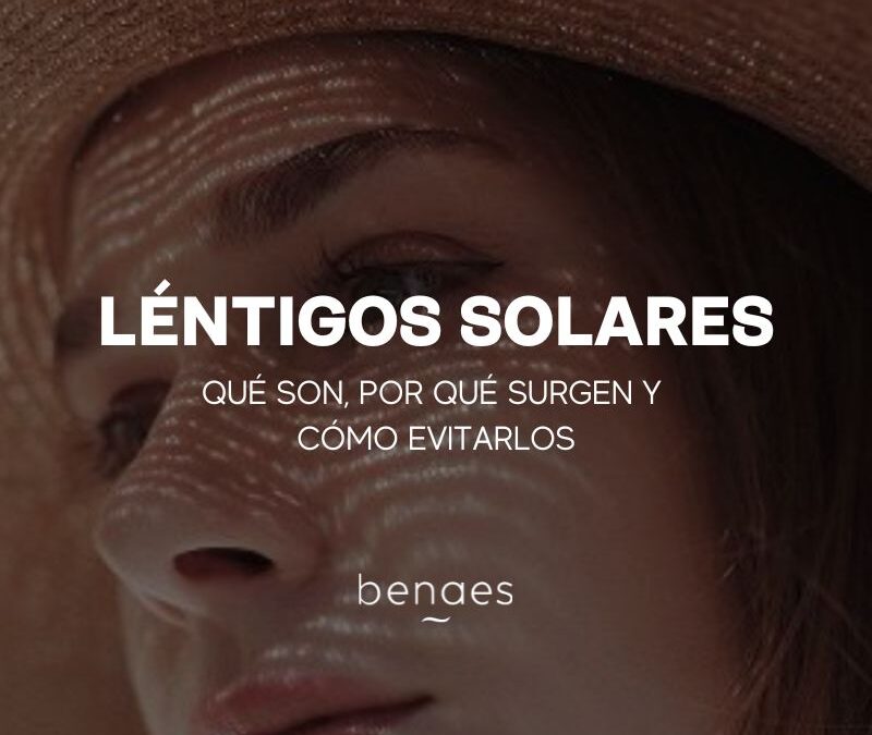 Léntigos Solares: Qué son, Por qué surgen y Cómo evitarlos