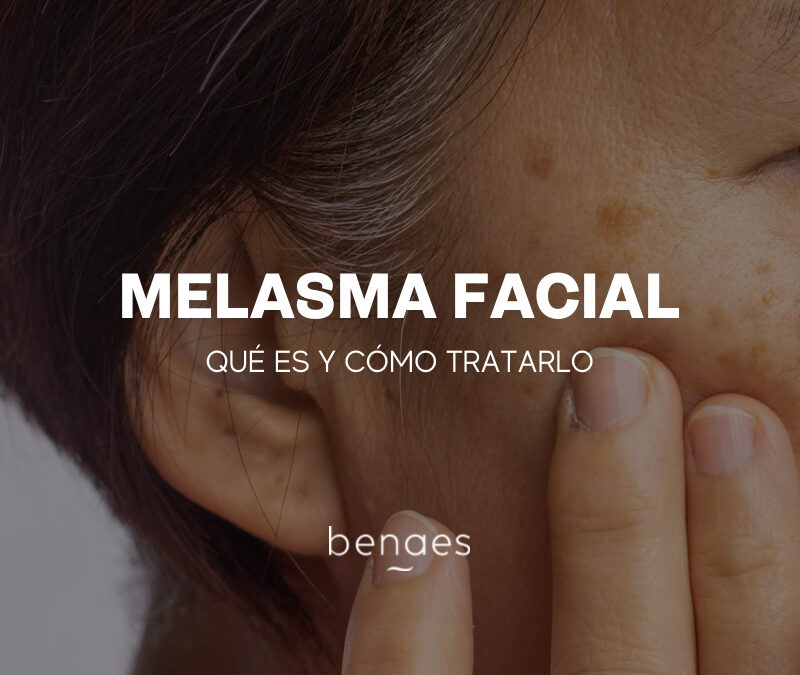 Melasma Facial: Qué es y cómo tratarlo